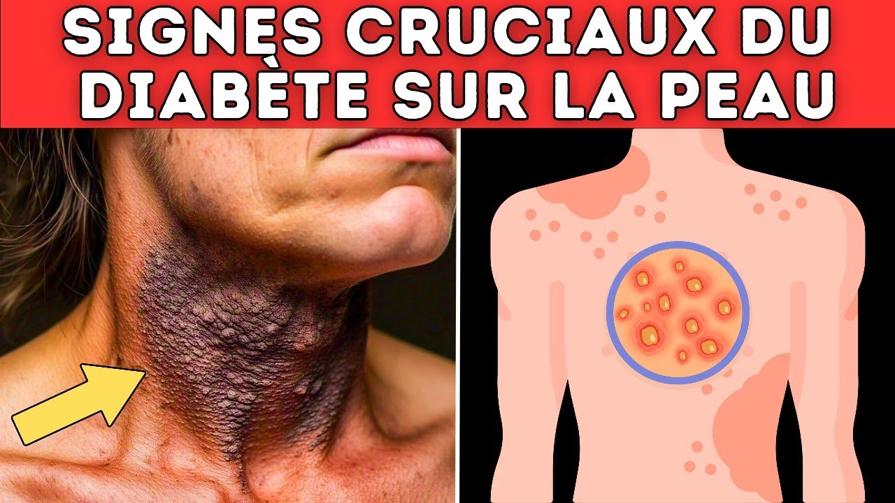 Attention : 7 signes sur la peau qui peuvent r&eacute;v&eacute;ler le diab&egrave;te et que peu de gens remarquent