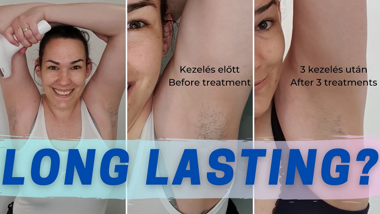 Lézeres szőrtelenítés után 2 hónappal update videó [ 2 month update video after laser hair removal ]