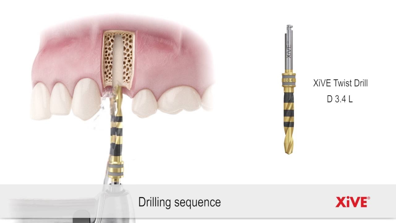 Xive Drilling sequence and implant placement