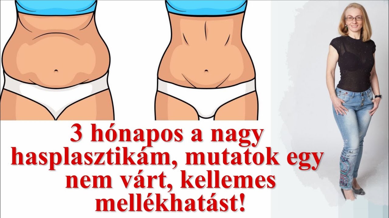 3 hónappal a hasplasztika után - egy nem várt, pozitív 