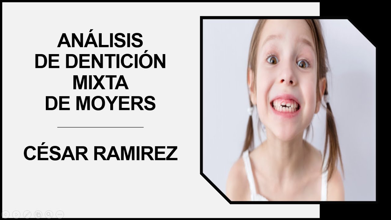 ANÁLISIS DE DENTICIÓN MIXTA DE MOYERS – 2022