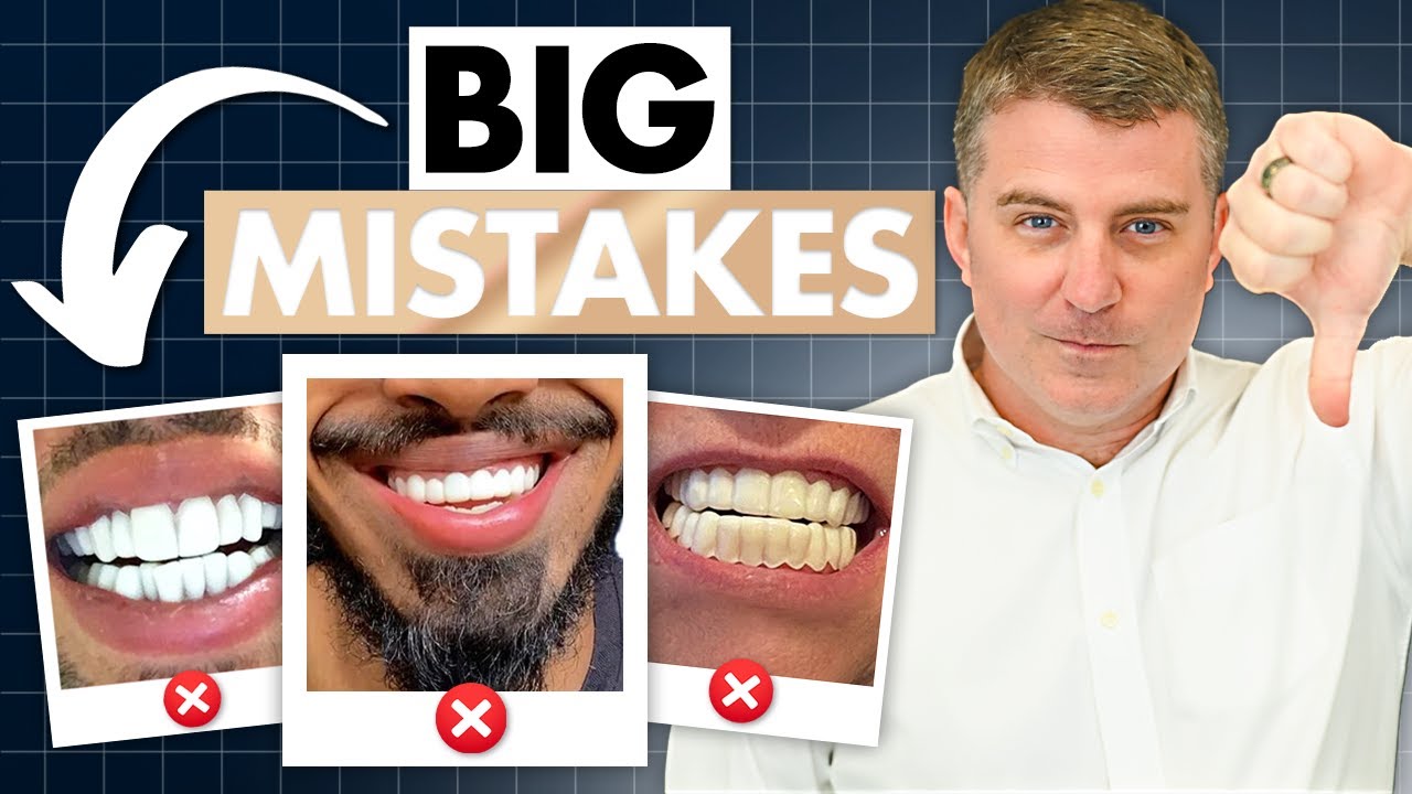 The Real Reason Why Cheap Veneers Look So Bad