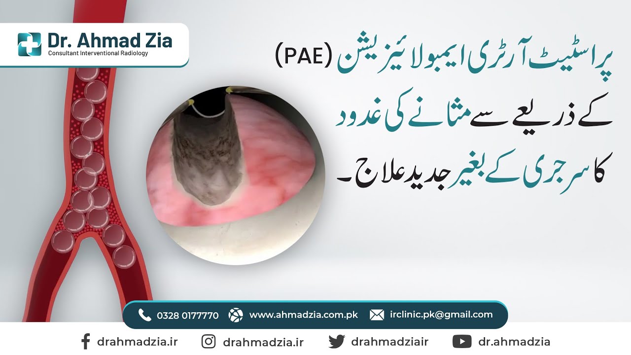 Advanced Non-surgical Treatment of Prostate Gland by PAE | Dr. Ahmad Zia IR Consultant