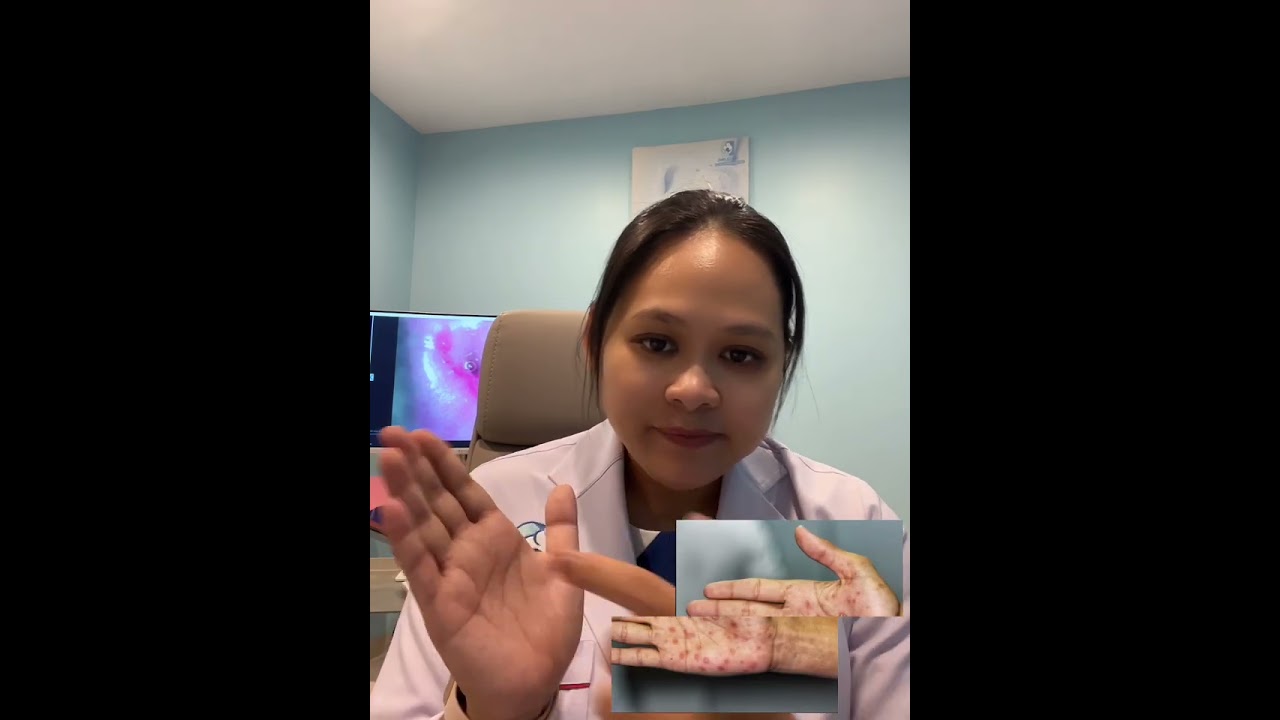 សញ្ញានៃជំងឺស្វាយ-Syphilis