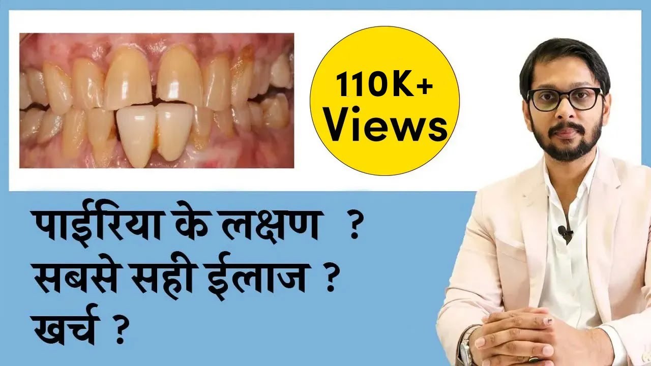 पायरिया क्या है ?? इसके कारण, लक्षण और इलाज । pyriya , periodontitis causes, symptoms & treatment