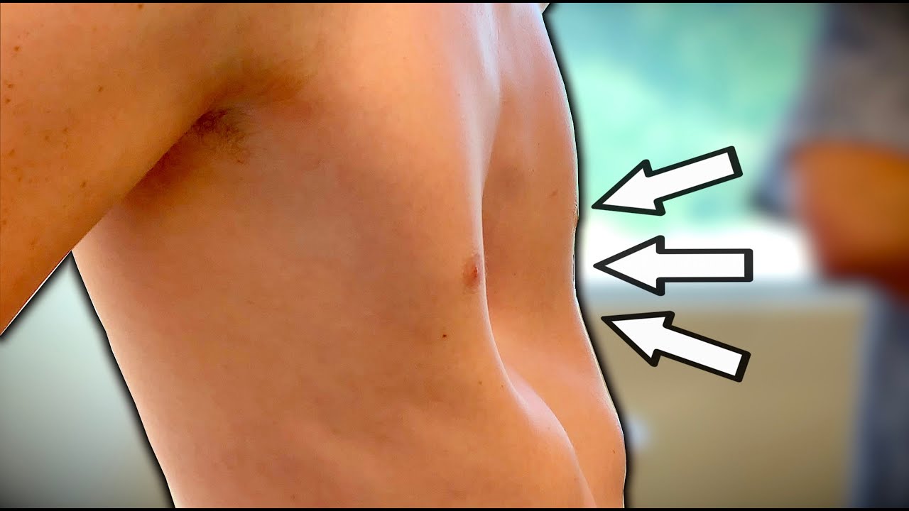 HIS CHEST IS CAVING IN... is this dangerous? (Pectus  Excavatum)