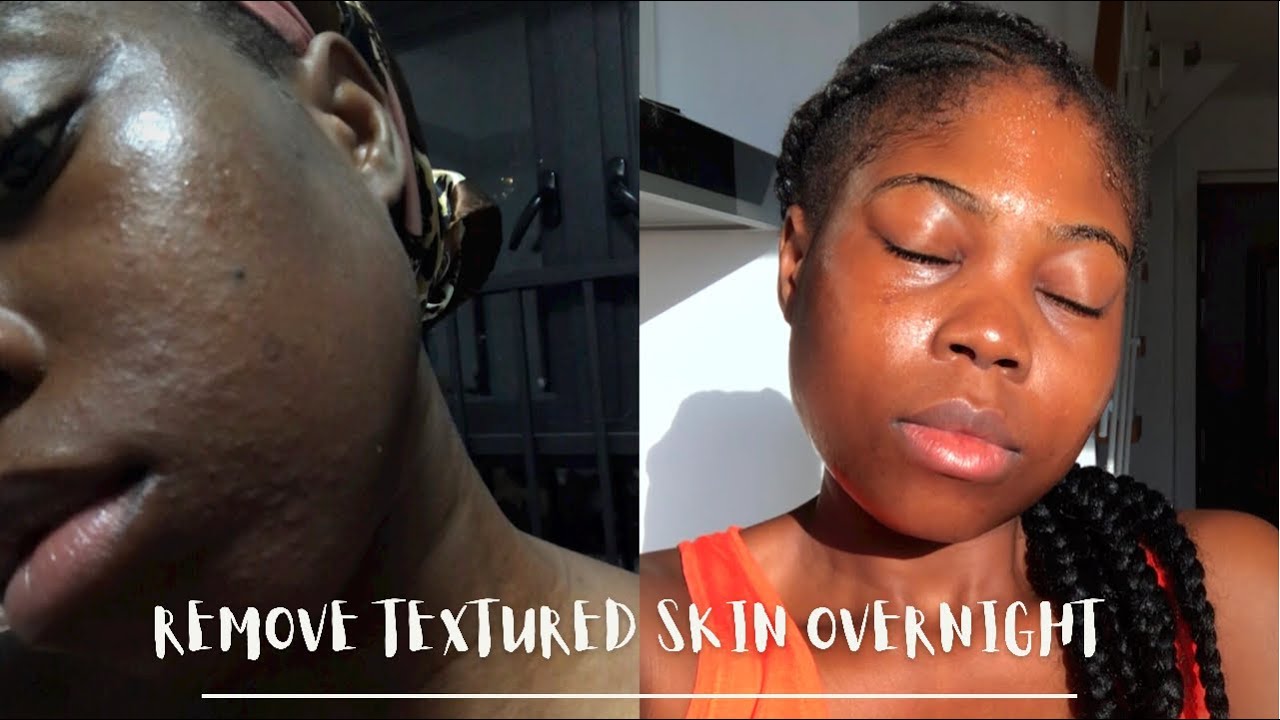 HOW TO SMOOTH TEXTURED SKIN & SKIN RASH OVERNIGHT NATURALLY - using only 1 ingredient | Merveille K
