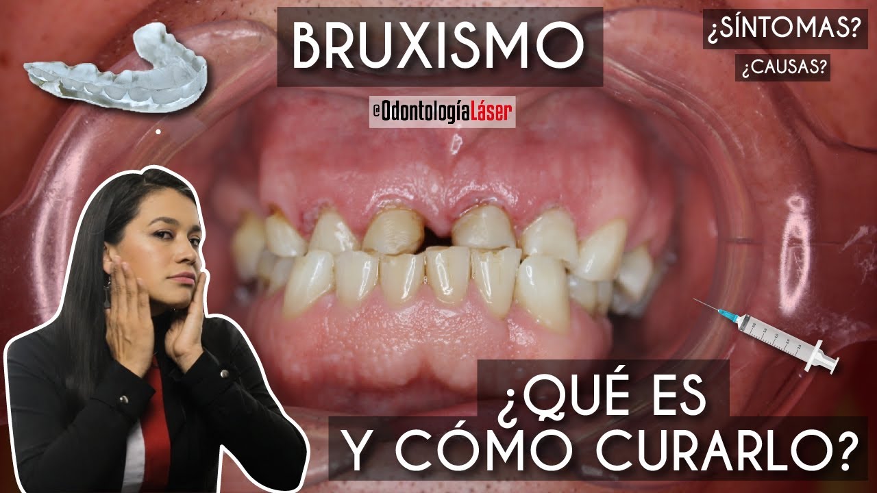 Bruxismo, 😬 ¿Qué es y cómo curarlo? ✅ - Odontología Láser.