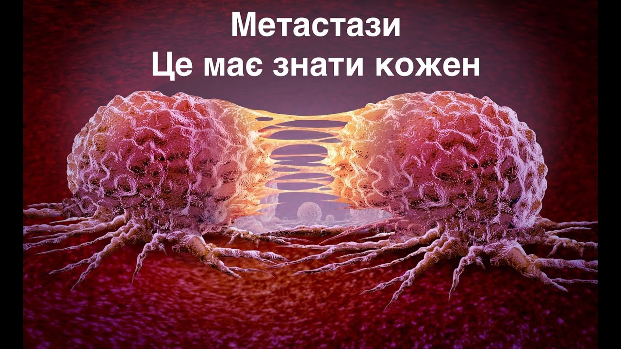 День 1. Метастази. Ці знання врятують життя.
