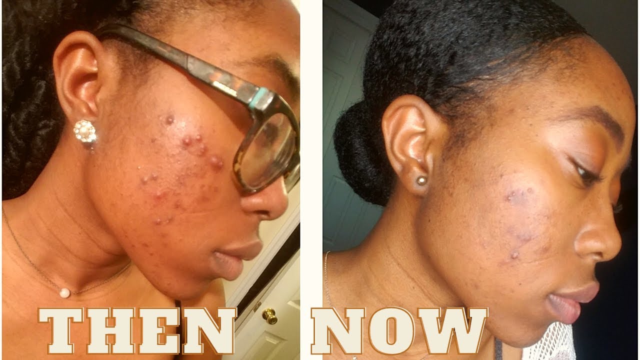 How I Naturally Cleared My Cystic Acne!