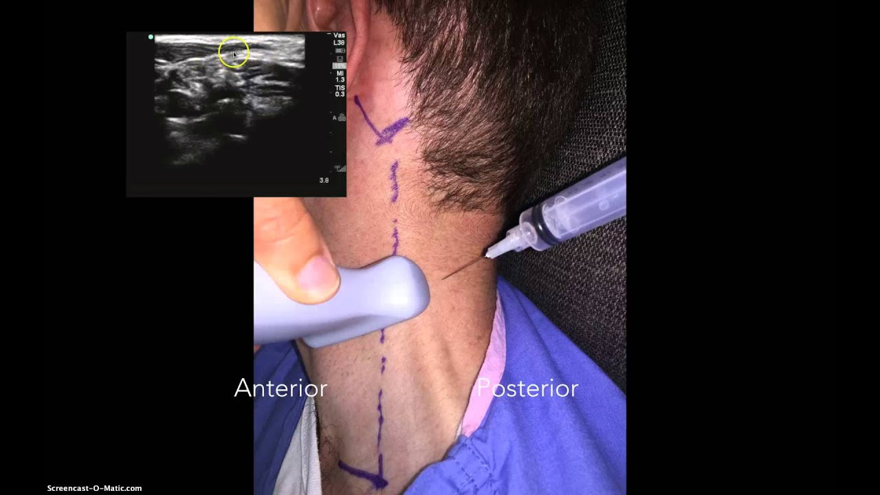 Cevical Plexus Nerve Block