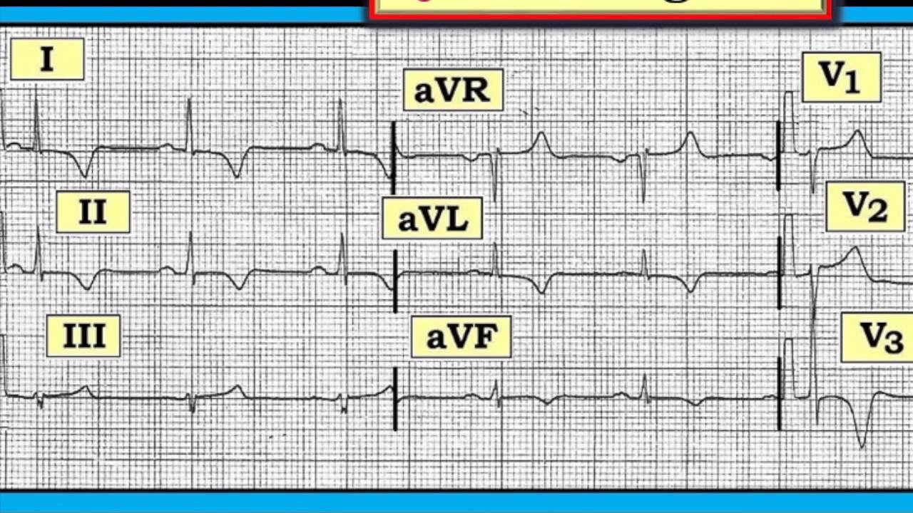 ECG Video-16 (Blog 120) - LV 