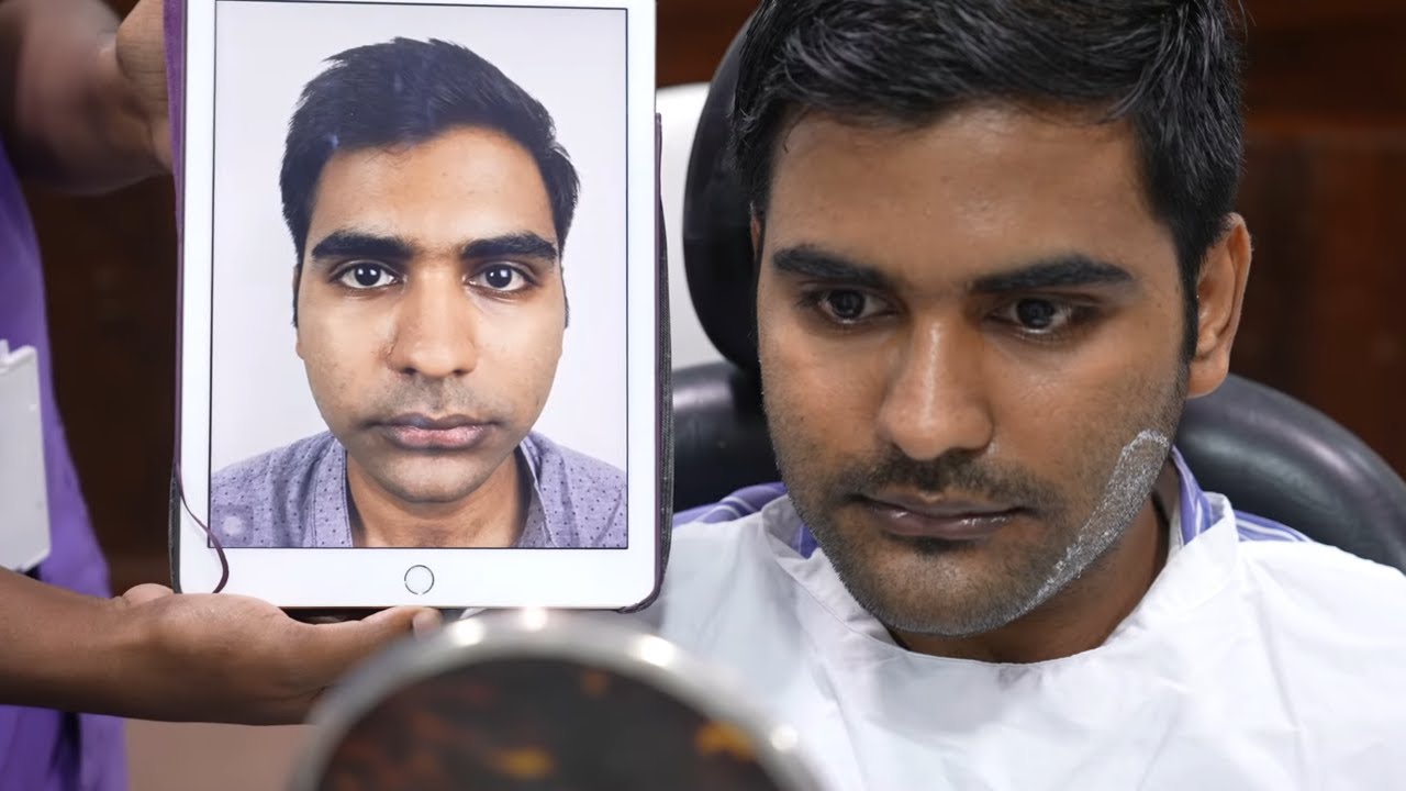 Young Bangladesh man Genioplasty Surgery Pack Removal -  Results after 7 days