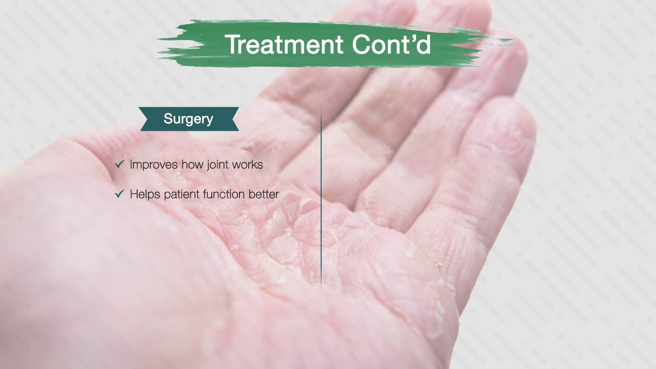 Psoriatic Arthritis Part 2