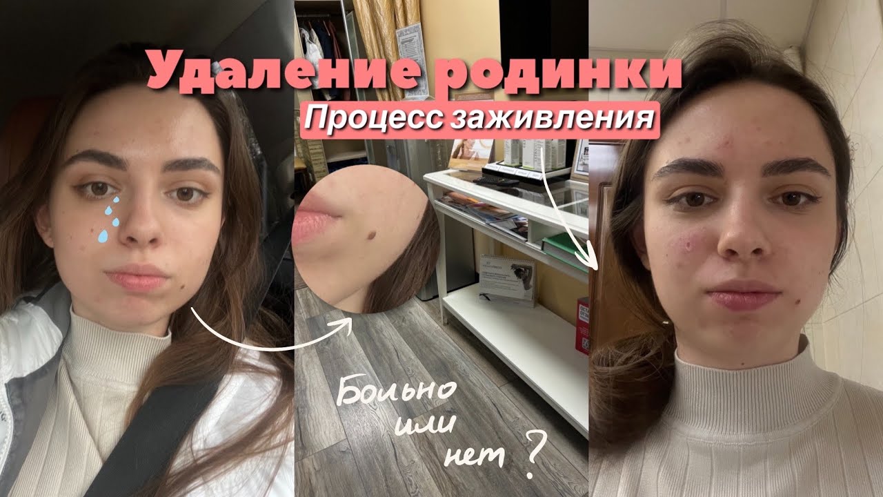 УДАЛЕНИЕ РОДИНОК НА ЛИЦЕ| ТЕЛЕ| МОЙ ОПЫТ| Процесс заживления
