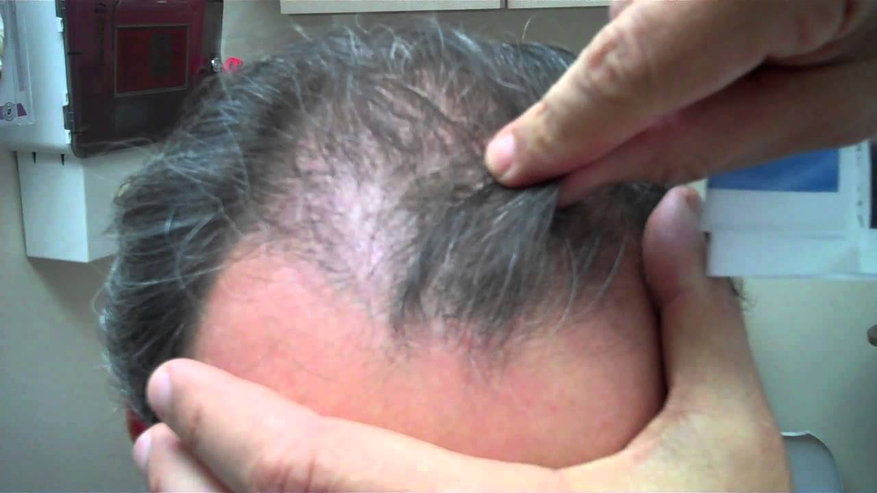 Dr. Jeffrey Epstein - Hair Transplant