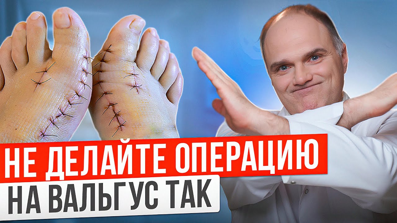 3 простых шага чтобы снизить риск рецидива косточки на ноге!