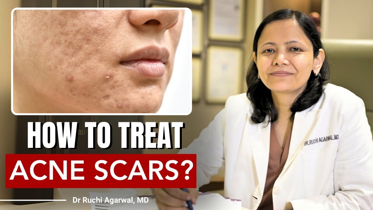 How to treat Acne Scars | Acne Scar Treatment | Acne Scars | Dr Ruchi Agarwal | Satya #acnescars