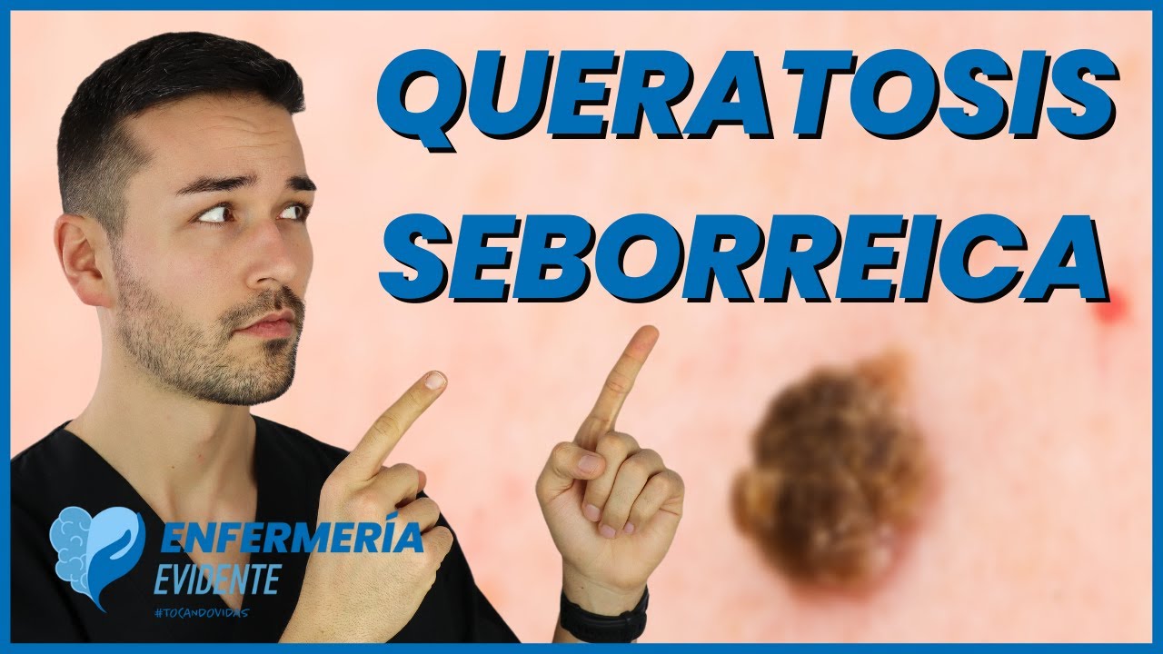 📢¿QUÉ es la QUERATOSIS SEBORREICA? 👁️  [CAUSAS y MANIFESTACIONES]