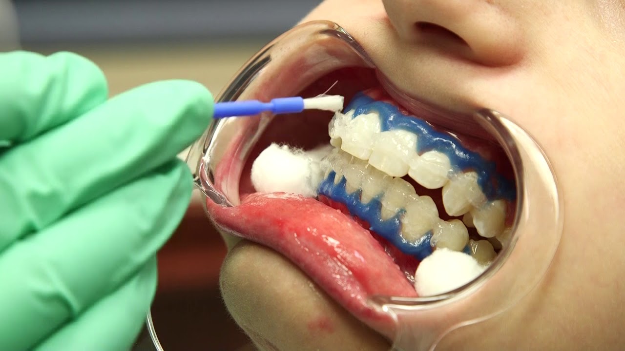 Shatkin iSmile Teeth Whitening