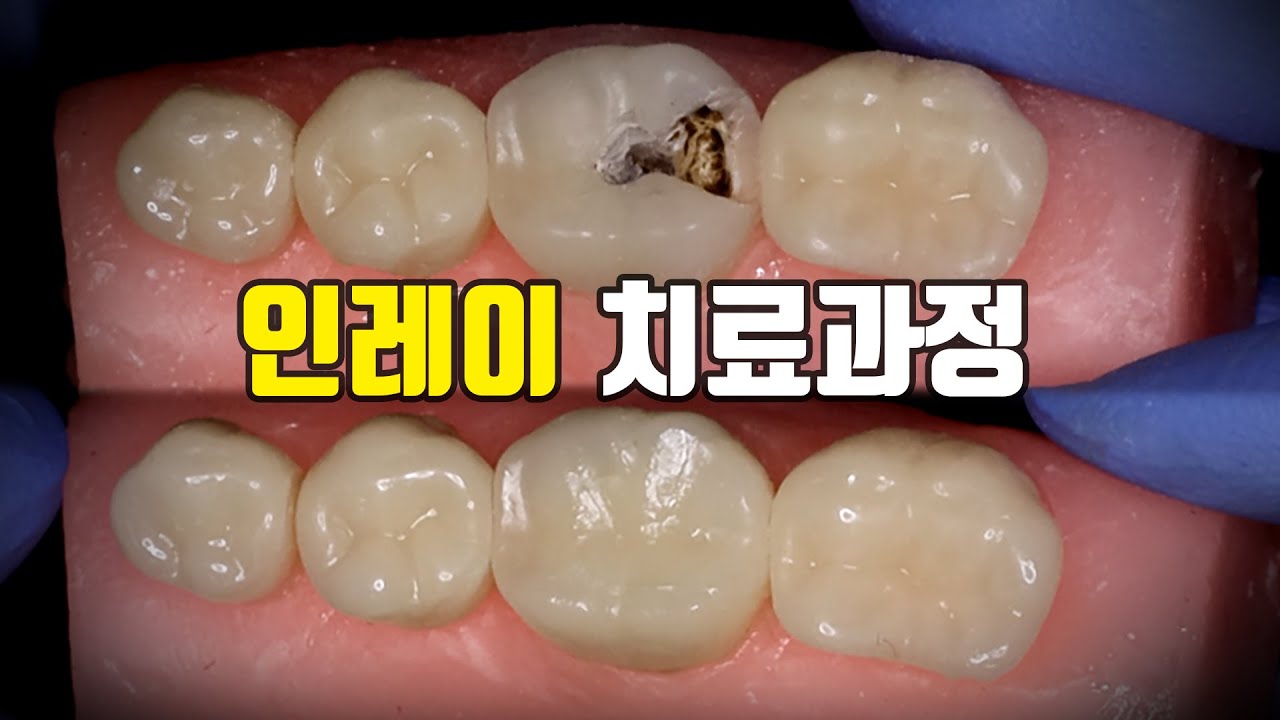 인레이 치과 치료과정
