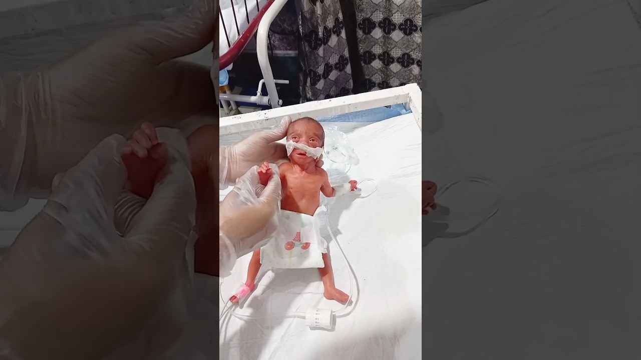 Premature Baby (6 Months, 0.6kg) in Critical Condition – Oxygen Dependent #neonatologist #newborn