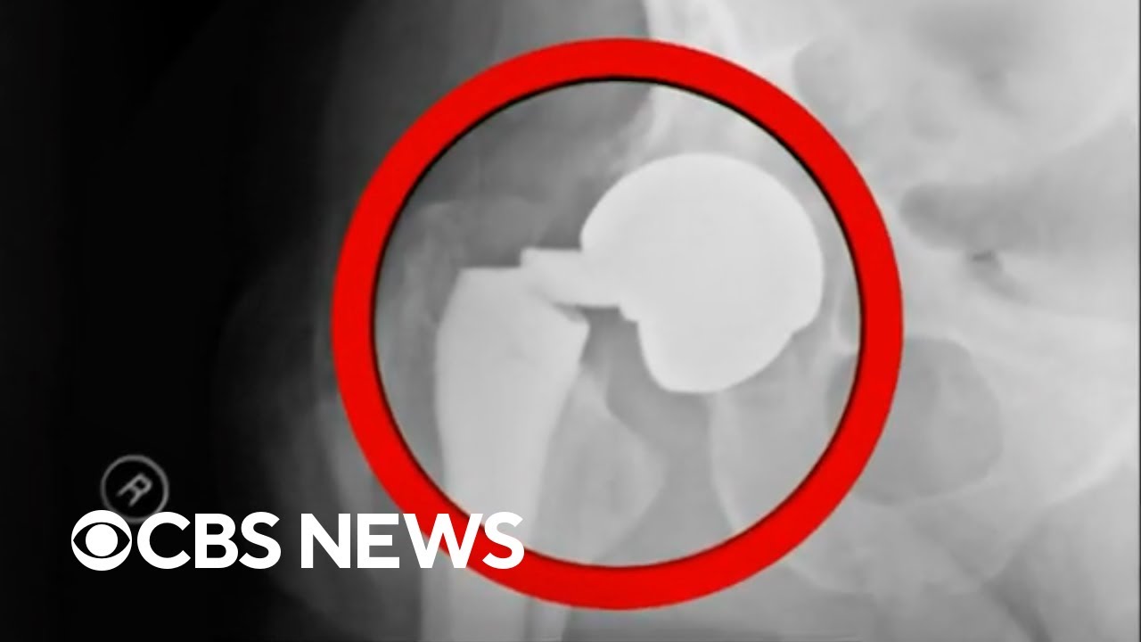 Titanium hip implants expected to last decades snapped in hundreds of patients