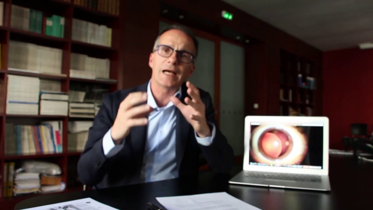 Les principaux signes ophtalmologiques du syndrome de Marfan