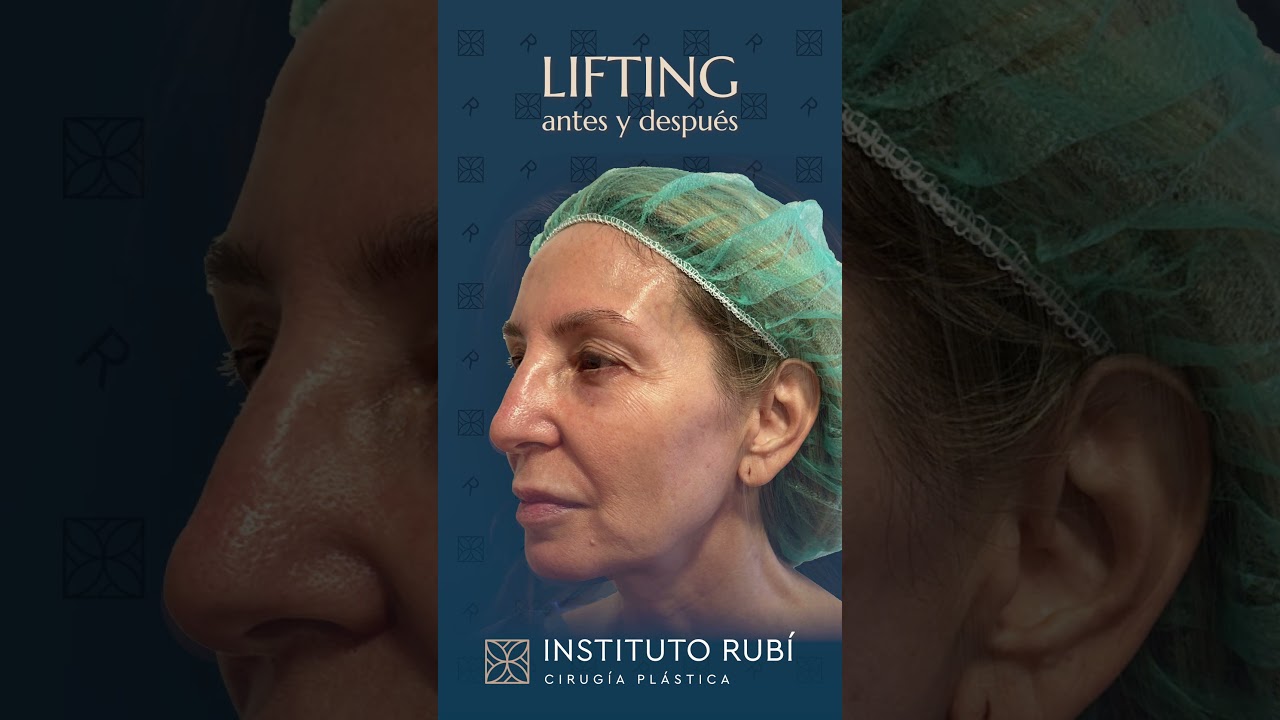 Resultado antes y despu&eacute;s de cirug&iacute;a pl&aacute;stica de LIFTING por el Dr. Rub&iacute;