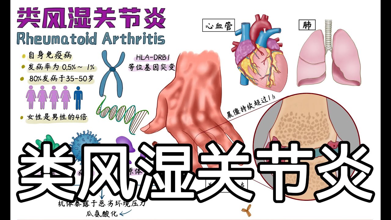 手绘精讲 【类风湿关节炎】病因机制+症状+诊断+治疗[Rheumatoid Arthritis] etiology + symptoms + diagnosis + treatment