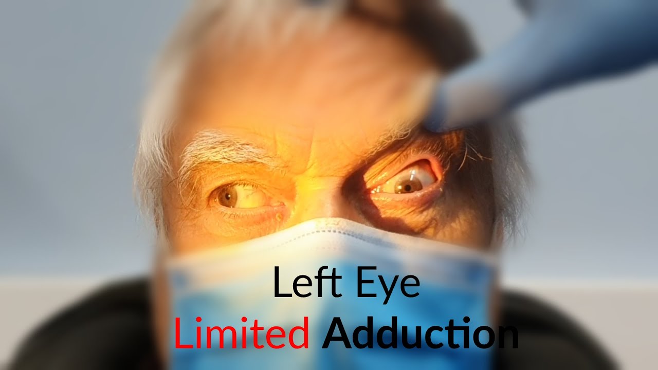THIRD NERVE PALSY - PUPIL SPARING