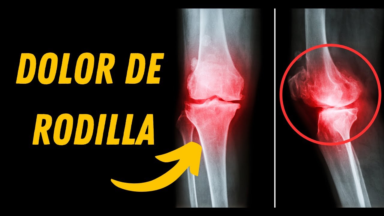DOLOR DE RODILLA: ¿CÓMO MANEJARLO Y QUÉ COMER?