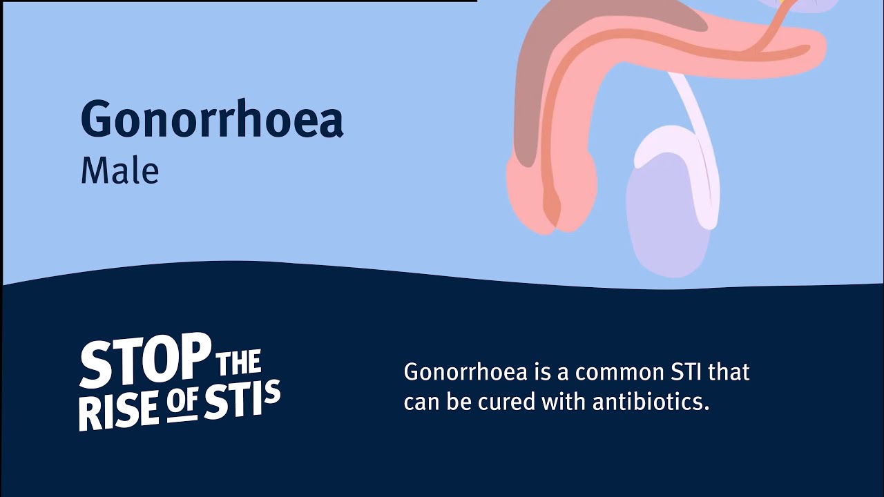 Sexual Health - Gonorrhoea (Male)