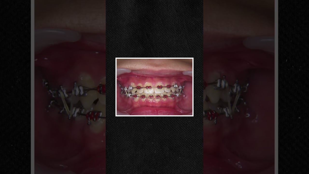 18 Months of Braces in 18 Seconds !