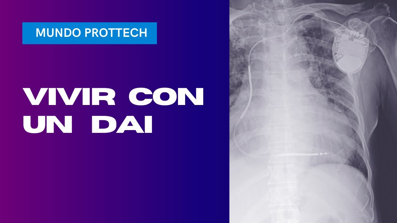 Vivir con desfibrilador: gu&iacute;a completa DAI - Ejercicio, vida normal y consejos