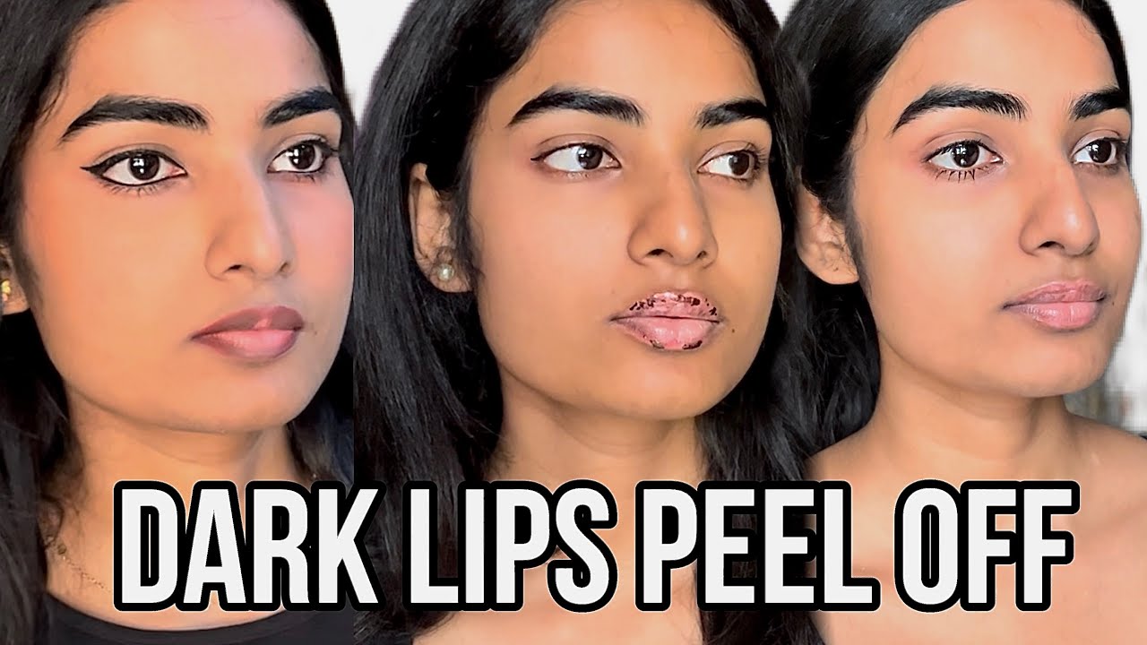 Treating my HYPER-PIGMENTED Dark Lips | Lip Peel ? LASER? Chemical?