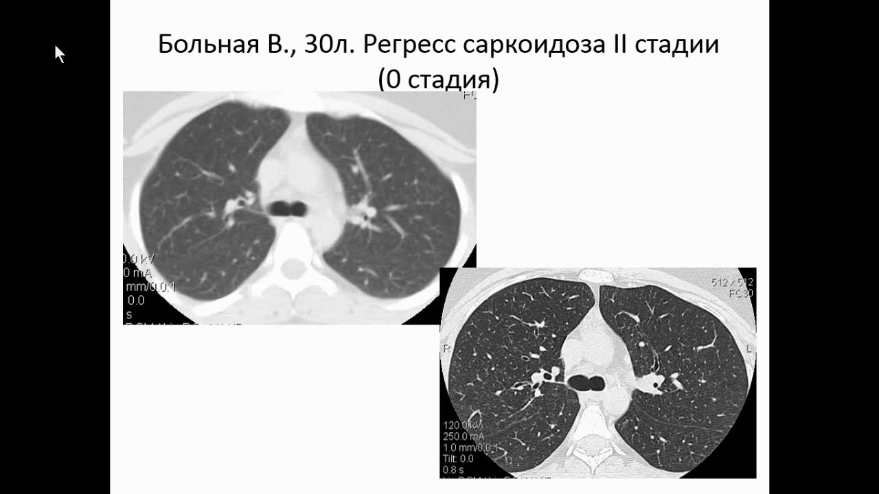 Сперанская А.А. «Лучевая диагностика прогрессирующего саркоидоза»