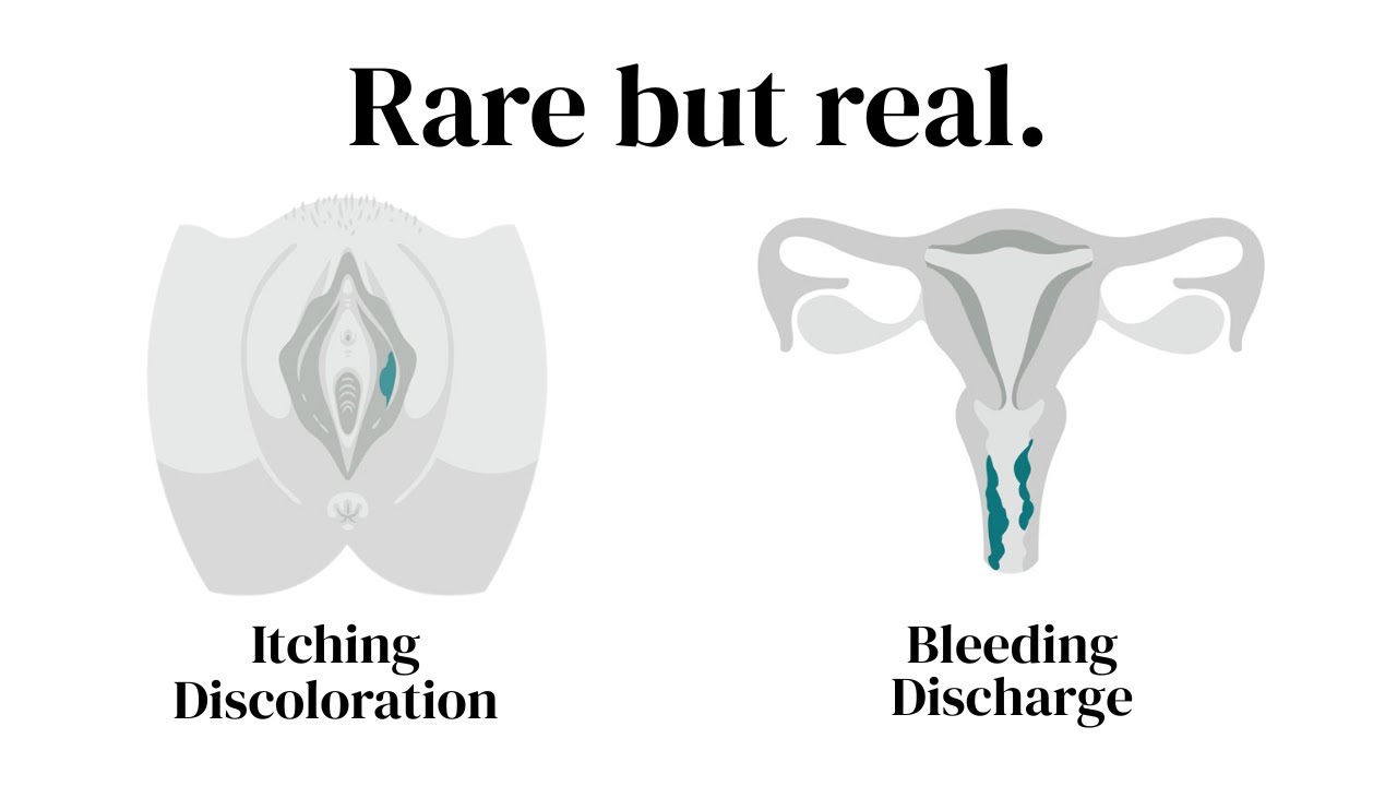 Vulvar and Vaginal Cancer: What every woman should know!