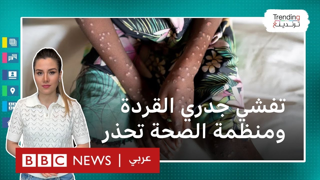 جدري القردة: منظمة الصحة العالمية تعلن حالة طوارئ صحية عالمية