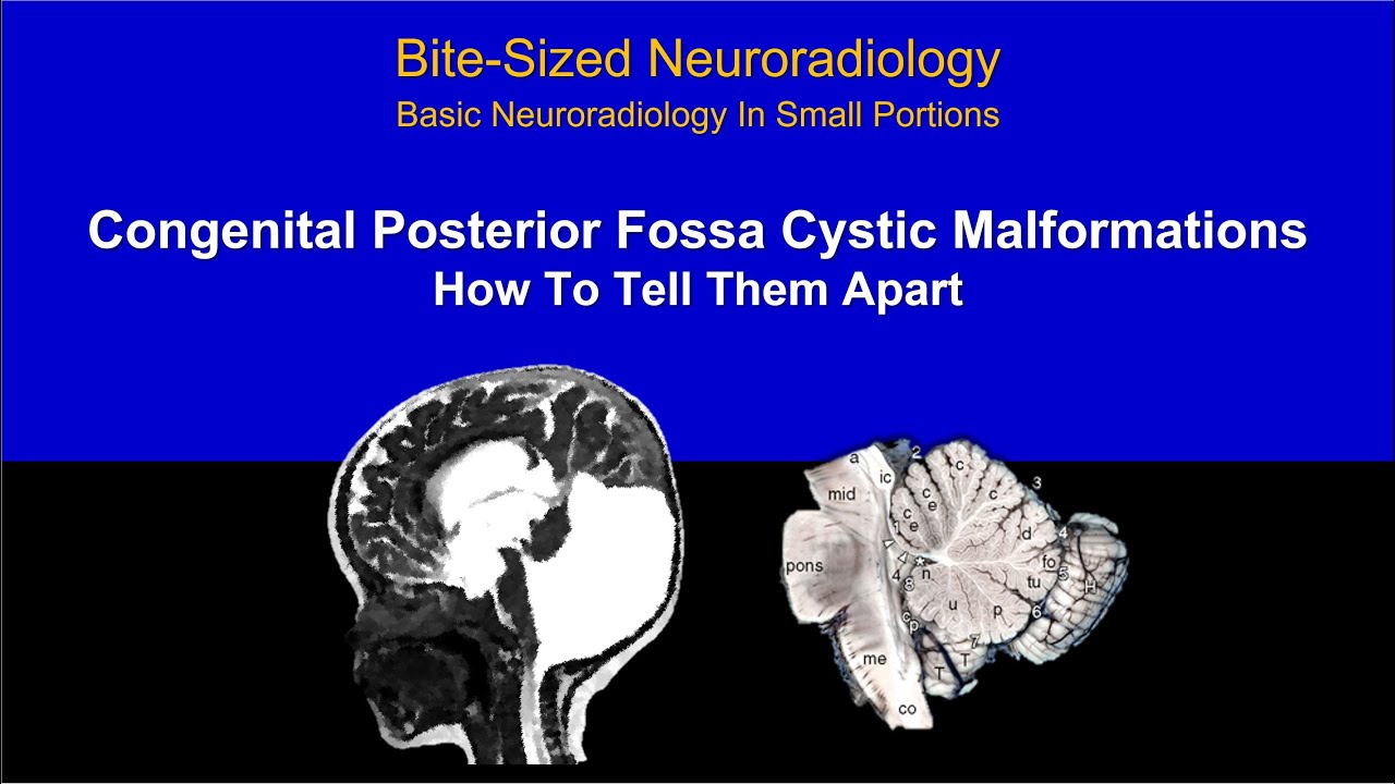 Posterior Fossa Cystic Malformations Made Easy - How To Tell Them Apart