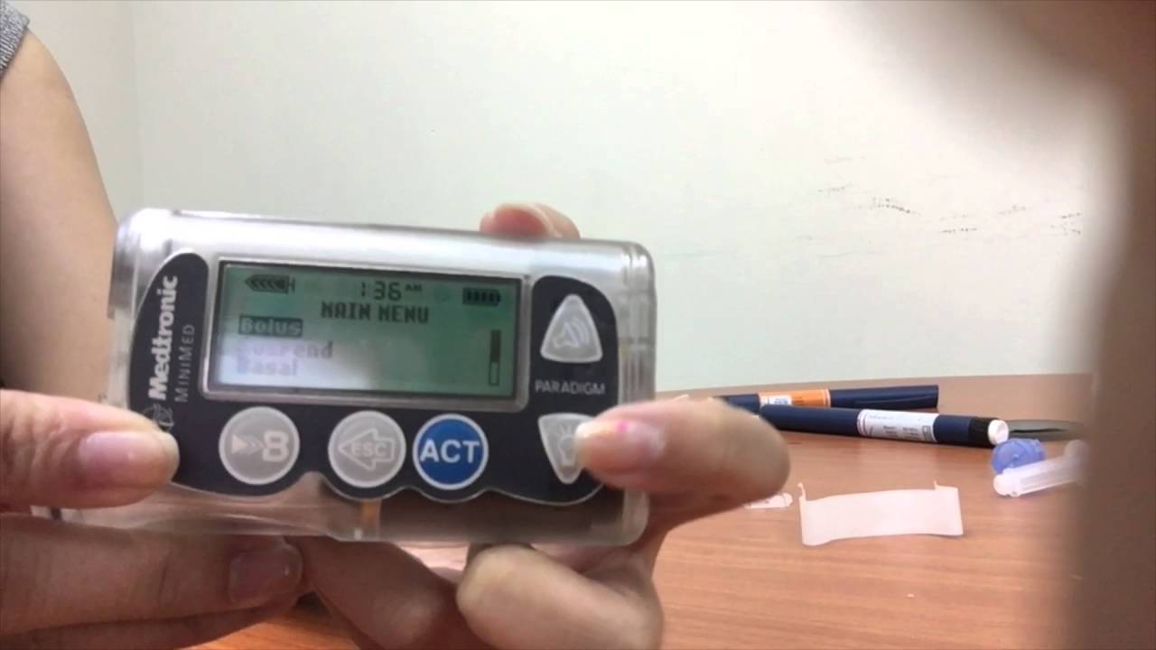 Sure T infusion set change - Minimed Paradigm x15