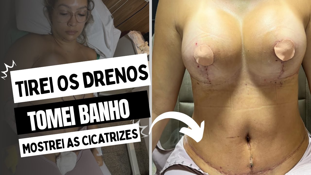 DIÁRIO DA CIRURGIA TRIPLA: COMO FORAM OS15 DIAS APÓS