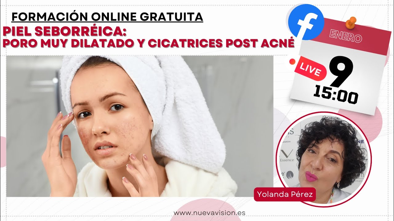 Piel seborreica, poro muy dilatado y cicatrices post acne