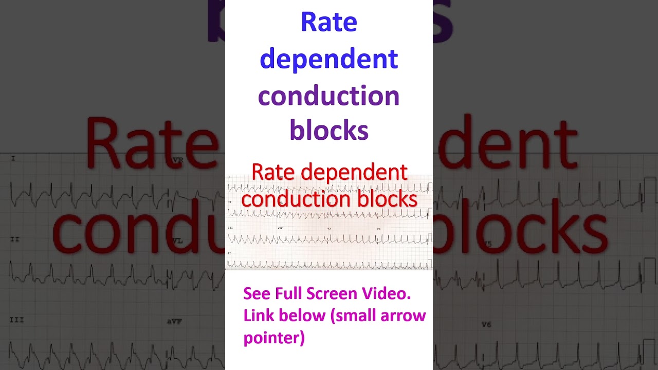 Rate dependent conduction blocks