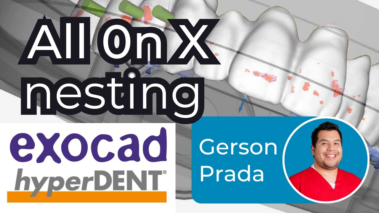 All on X exocad design nesting into hyperDENT - ep #0006