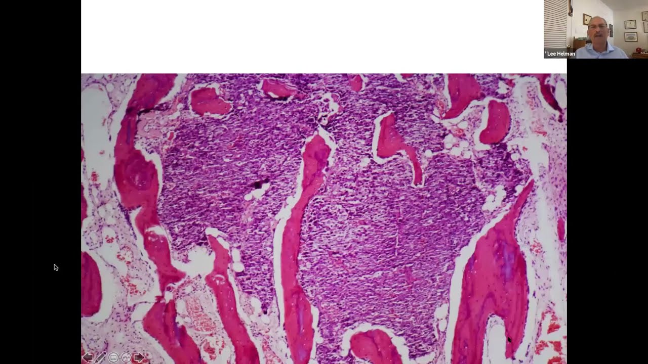 Osteosarcoma: New Treatments/Research - Sarcoma Exchange 2021