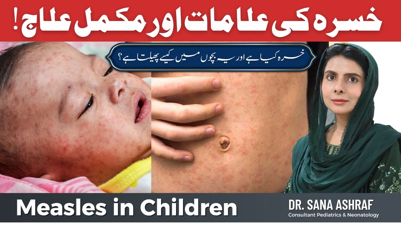 📹 Measles in Children – Causes, Symptoms & Prevention