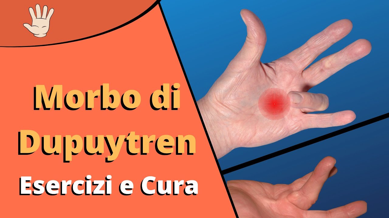Morbo di Dupuytren, i migliori Esercizi e la Cura