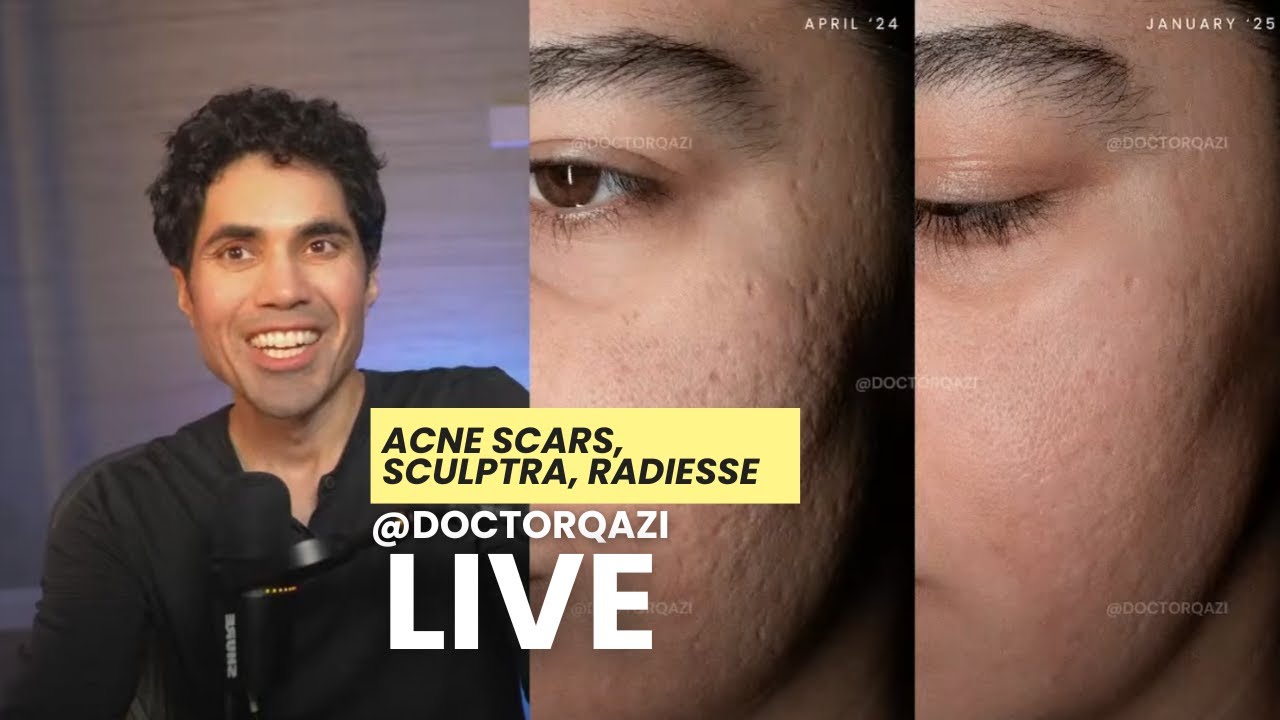 Доктор Кази рассказывает о шрамах от угревой сыпи, препаратах Sculptra, Radiesse и Bellafill | Не...