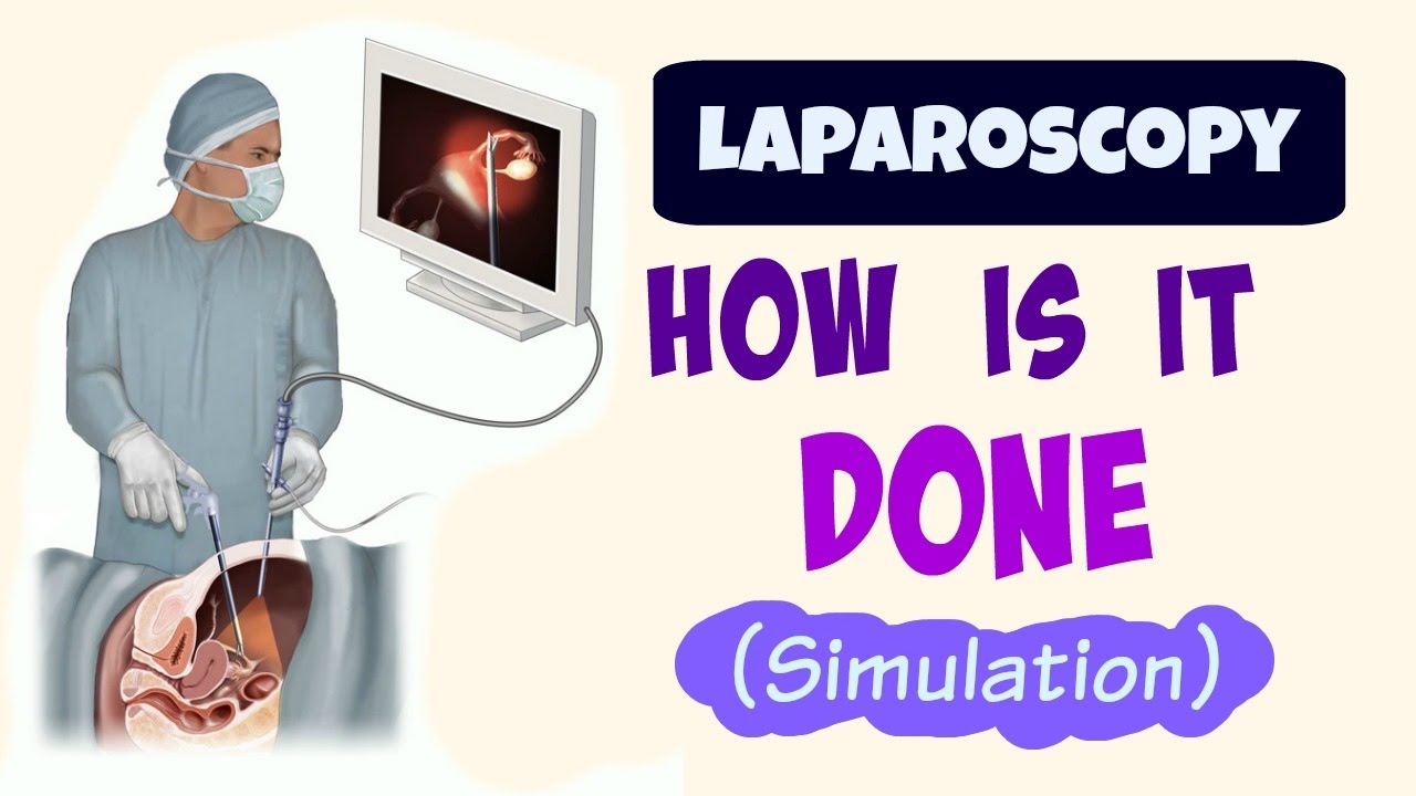 Laparoscopic Surgery: How is it done (simulation)